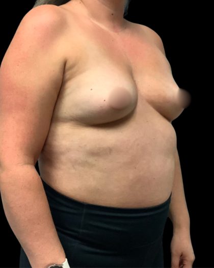 Breast Augmentation Before & After Patient #6873