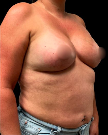 Breast Augmentation Before & After Patient #6873