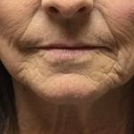Injection Before & After Patient #6909