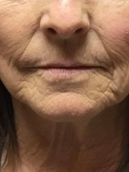 Injection Before & After Patient #6909