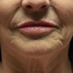 Injection Before & After Patient #6909
