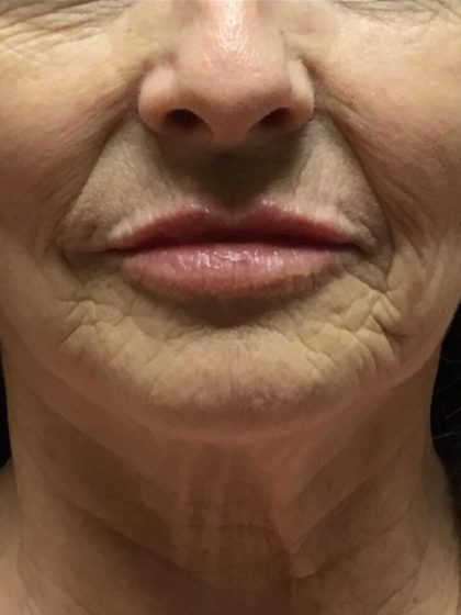 Injection Before & After Patient #6909