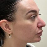Injection Before & After Patient #6910