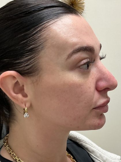 Injection Before & After Patient #6910