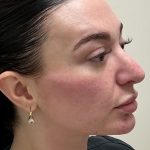 Injection Before & After Patient #6910