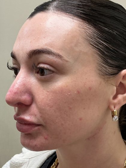 Injection Before & After Patient #6910