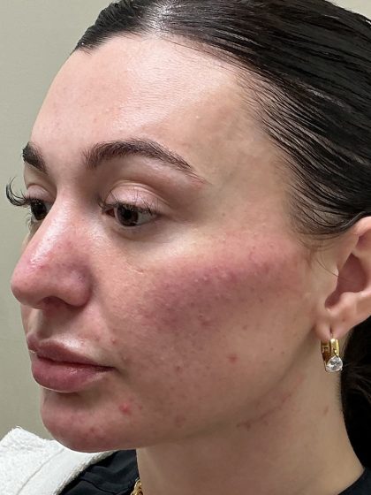 Injection Before & After Patient #6910