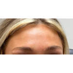 Injection Before & After Patient #6913
