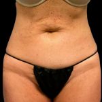 Tummy Tuck Before & After Patient #6972