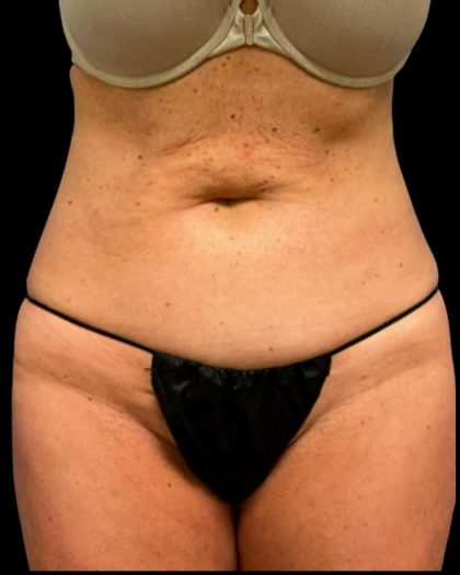 Tummy Tuck Before & After Patient #6972