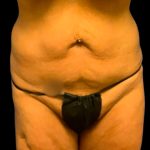 Tummy Tuck Before & After Patient #7026