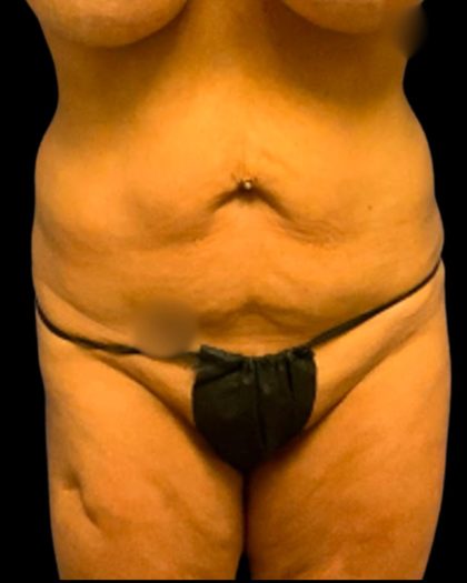 Tummy Tuck Before & After Patient #7026