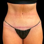 Tummy Tuck Before & After Patient #6972