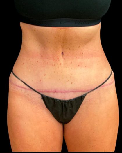 Tummy Tuck Before & After Patient #6972