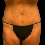 Tummy Tuck Before & After Patient #7026