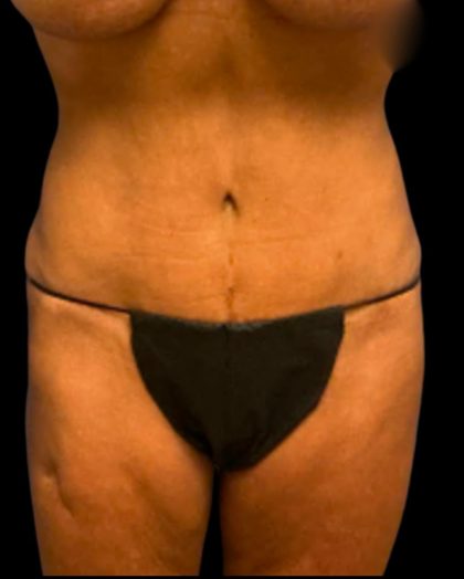 Tummy Tuck Before & After Patient #7026
