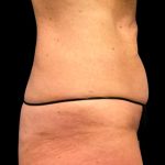 Tummy Tuck Before & After Patient #6972
