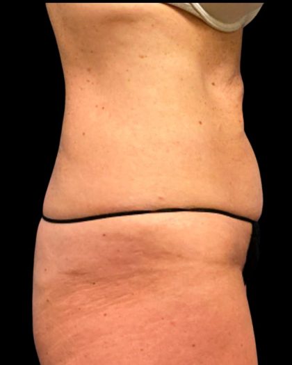 Tummy Tuck Before & After Patient #6972