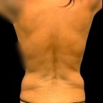 Tummy Tuck Before & After Patient #7026