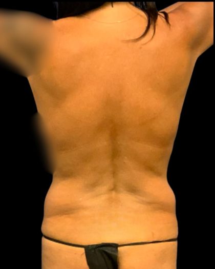 Tummy Tuck Before & After Patient #7026