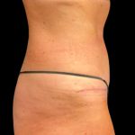 Tummy Tuck Before & After Patient #6972