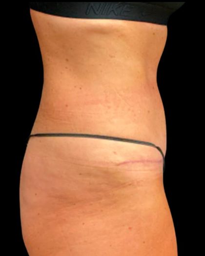 Tummy Tuck Before & After Patient #6972