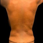 Tummy Tuck Before & After Patient #7026