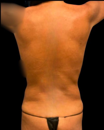 Tummy Tuck Before & After Patient #7026