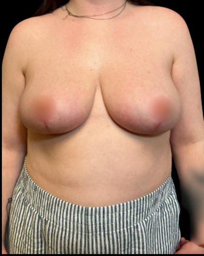 Breast Reduction Before & After Patient #6980