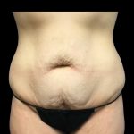 Tummy Tuck Before & After Patient #6981