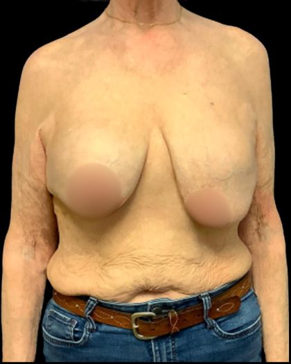Implant Exchange Before & After Patient #7036