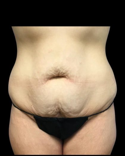 Tummy Tuck Before & After Patient #6981