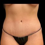 Tummy Tuck Before & After Patient #6981