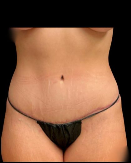 Tummy Tuck Before & After Patient #6981