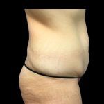 Tummy Tuck Before & After Patient #6981
