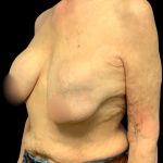 Implant Exchange Before & After Patient #7036