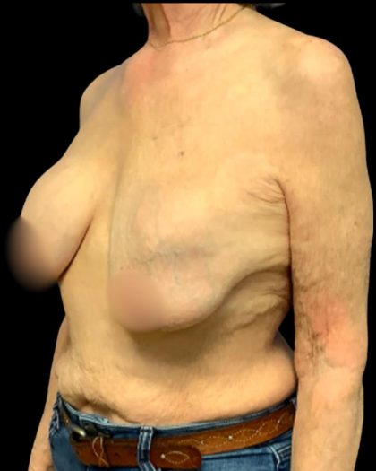 Implant Exchange Before & After Patient #7036