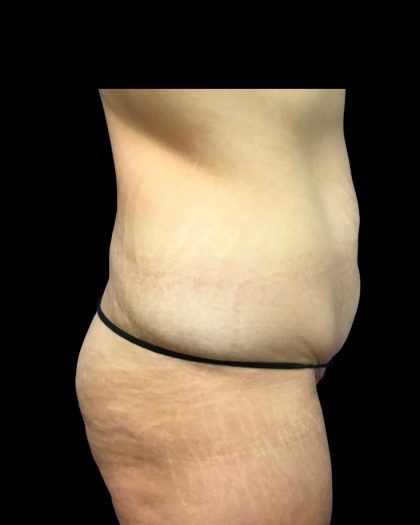 Tummy Tuck Before & After Patient #6981