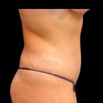 Tummy Tuck Before & After Patient #6981