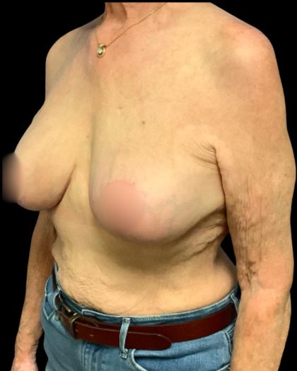 Implant Exchange Before & After Patient #7036