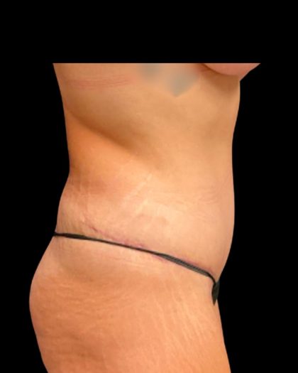 Tummy Tuck Before & After Patient #6981