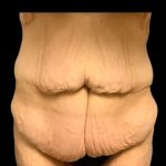 Fleur-de-lis Abdominoplasty Before & After Patient #7037