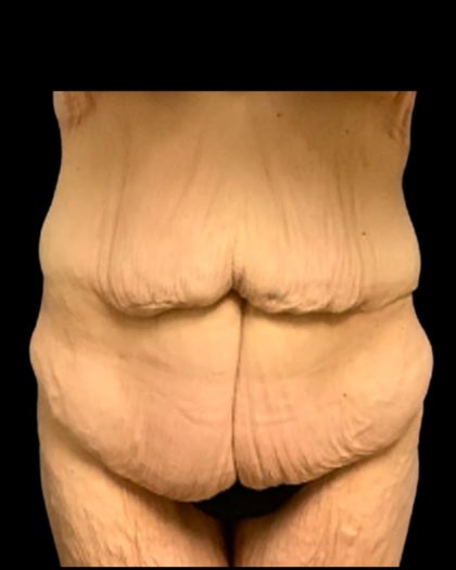 Fleur-de-lis Abdominoplasty Before & After Patient #7037