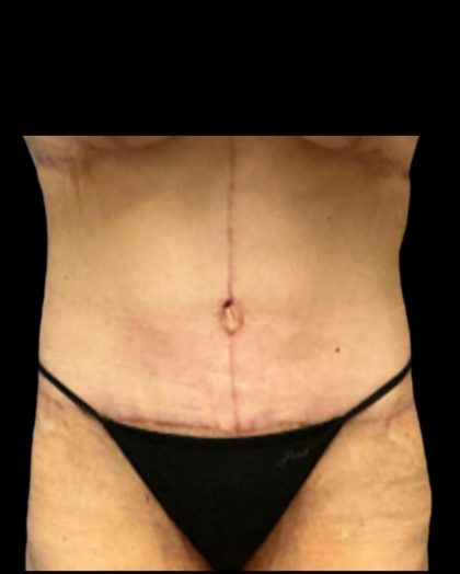 Fleur-de-lis Abdominoplasty Before & After Patient #7037