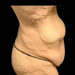 Fleur-de-lis Abdominoplasty Before & After Patient #7037