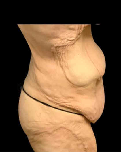 Fleur-de-lis Abdominoplasty Before & After Patient #7037