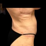 Fleur-de-lis Abdominoplasty Before & After Patient #7037