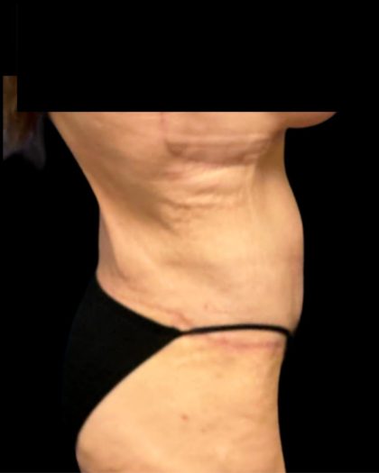 Fleur-de-lis Abdominoplasty Before & After Patient #7037