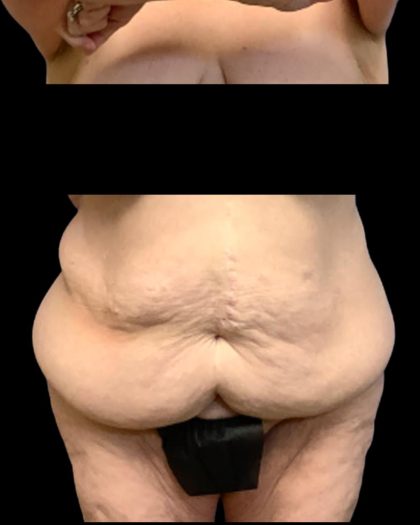 Circumferential Abdomen Before & After Patient #7038