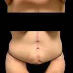Circumferential Abdomen Before & After Patient #7038